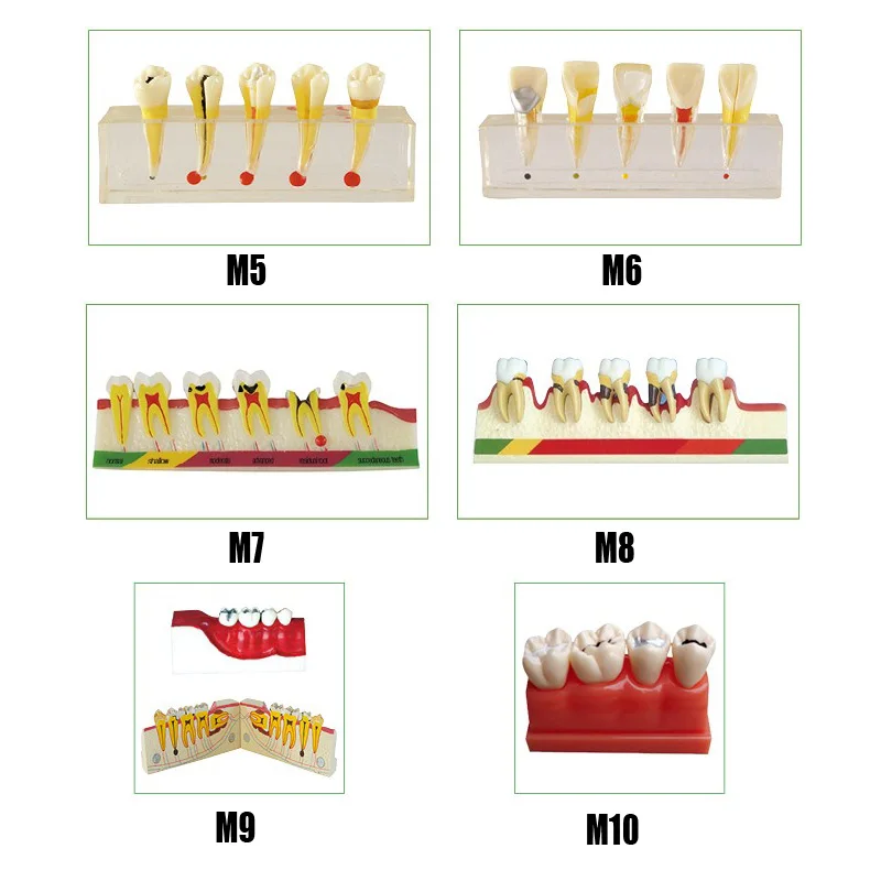 Dental Caries Disassembling Model teeth 4times Implant Model Disassembling teeth model Clinical Model
Dental Caries Disassembling Model teeth 4times Implant Model Disassembling teeth model Clinical Model