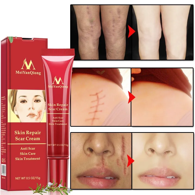 15g Acne Scar Stretch Marks Removal Cream Skin Repair Face Cream Acne Spots Treatment Blackhead Whitening Cream
15g Acne Scar Stretch Marks Removal Cream Skin Repair Face Cream Acne Spots Treatment Blackhead Whitening Cream