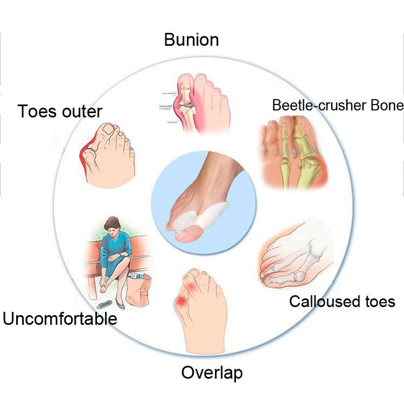 2 Pairs Silicone Gel Bunion Splint Big Toe Separator Overlapping Spreader Protection Corrector Hallux Valgus Separador De Dedos
2 Pairs Silicone Gel Bunion Splint Big Toe Separator Overlapping Spreader Protection Corrector Hallux Valgus Separador De Dedos