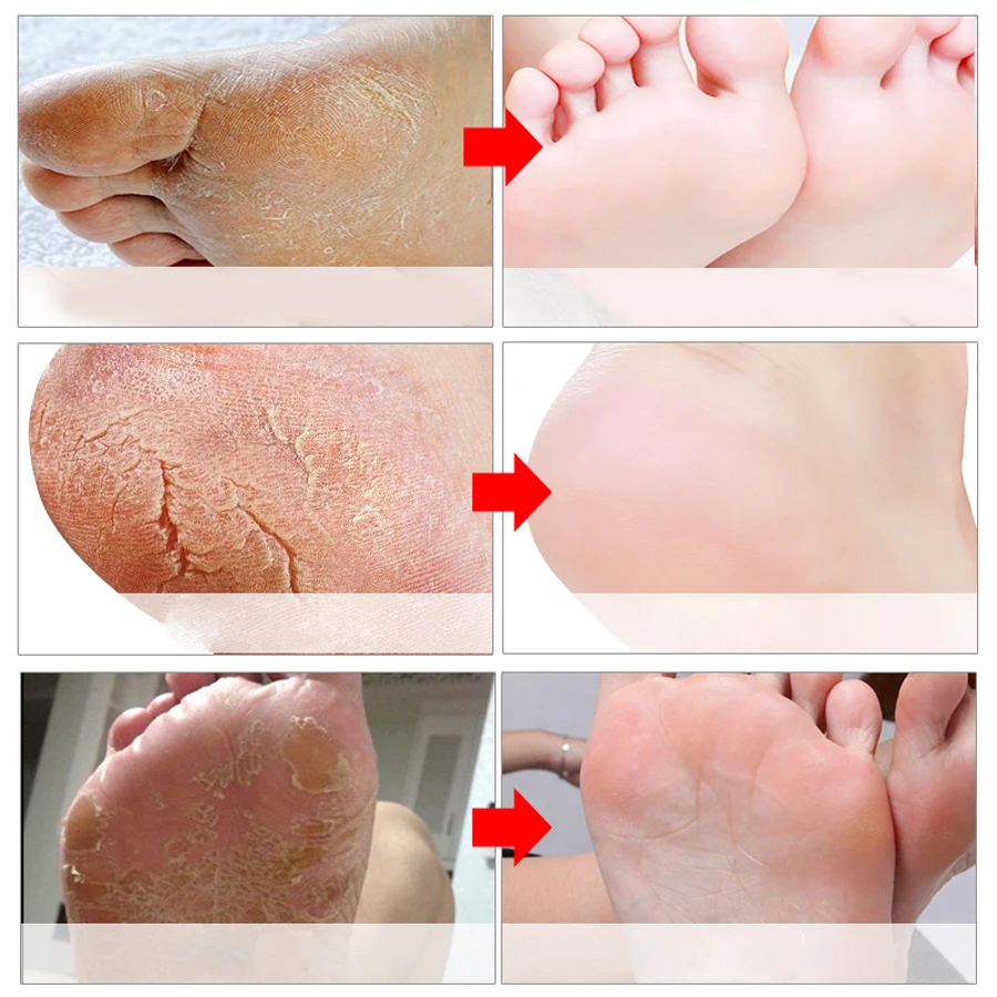 10Pcs/5Pair Detox Foot Peeling Masks for Legs Heels Pedicure Socks Whitening Exfoliating Soft Exfoliating Foot Mask Scrub
10Pcs/5Pair Detox Foot Peeling Masks for Legs Heels Pedicure Socks Whitening Exfoliating Soft Exfoliating Foot Mask Scrub