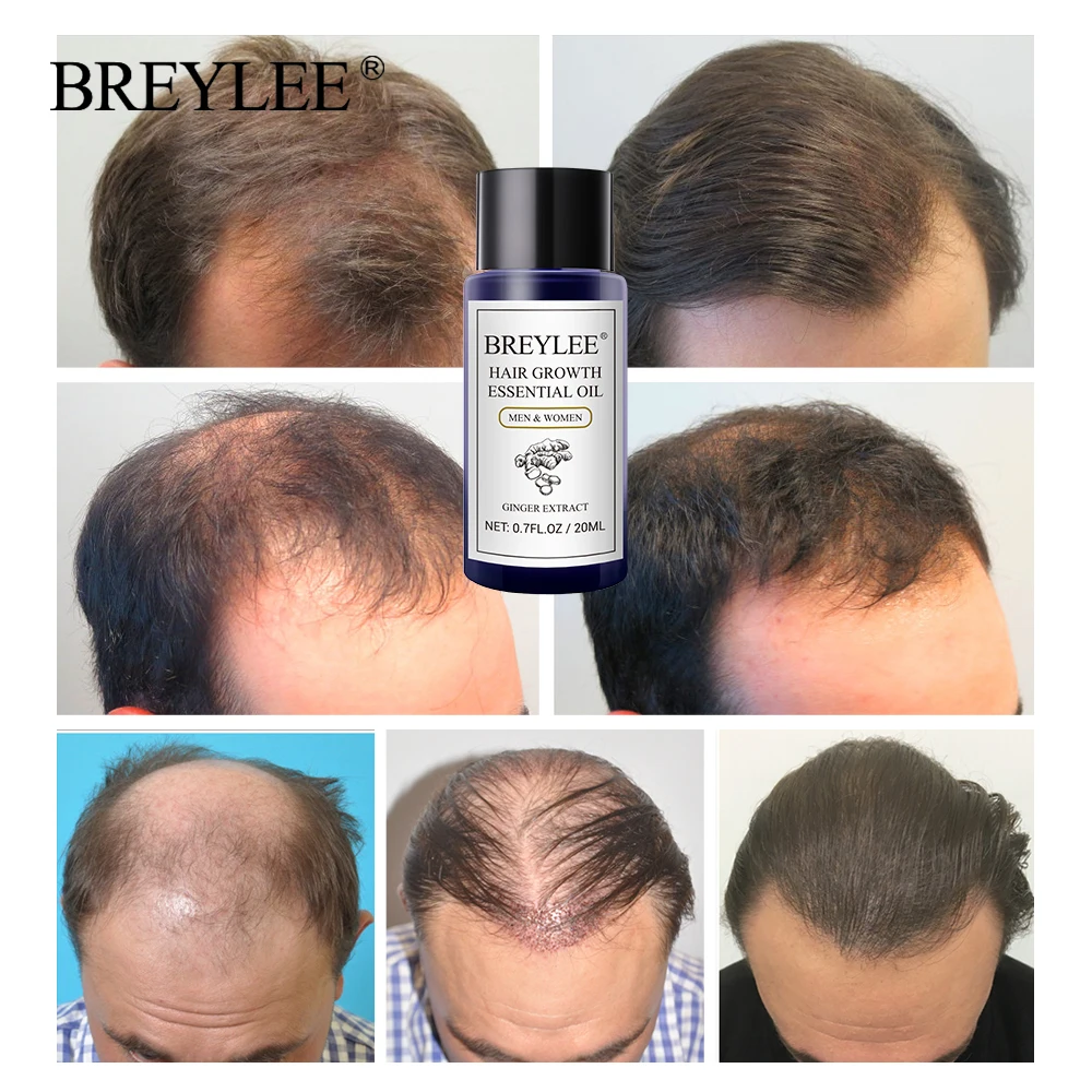 BREYLEE Hair Growth Essential Oil Hairdressing Anti-hair Loss Serum Powerful Hairs Products Prevent Nourishing Hair Care 20ml
BREYLEE Hair Growth Essential Oil Hairdressing Anti-hair Loss Serum Powerful Hairs Products Prevent Nourishing Hair Care 20ml