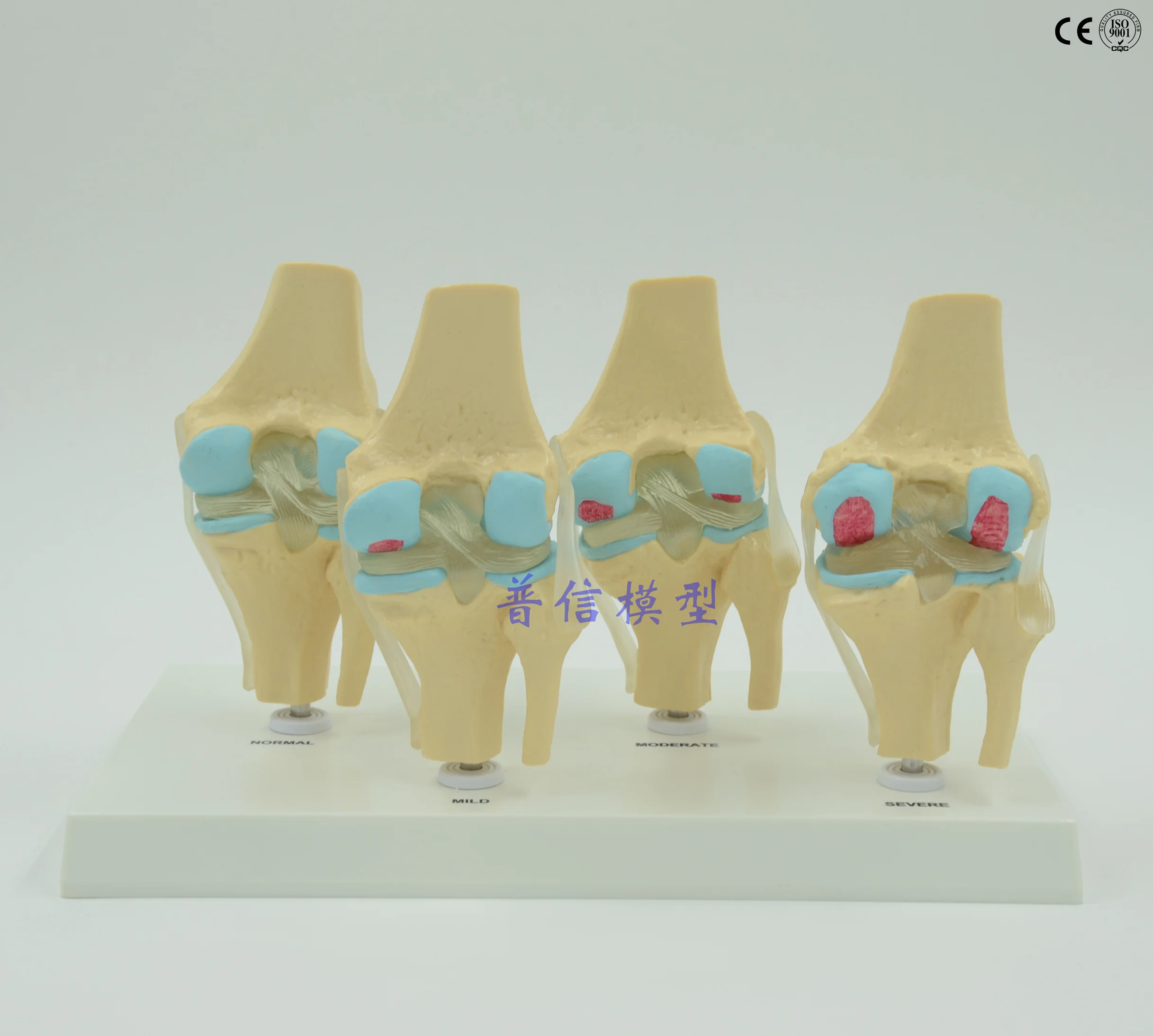 Free shipping&Human knee joint disease model, bone tissue, four stage knee joint model. Department of orthopedics model medical.
Free shipping&Human knee joint disease model, bone tissue, four stage knee joint model. Department of orthopedics model medical.