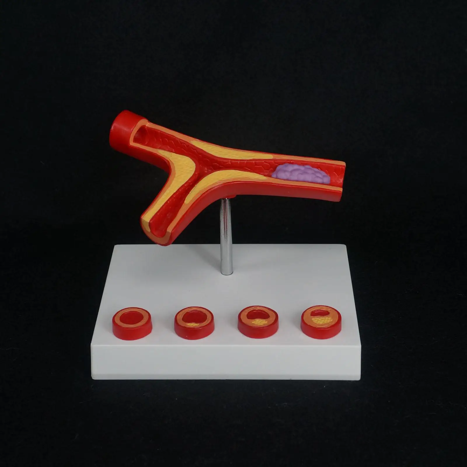 PVC Human Arterial Atherosclerosis Arteriosclerosis Model Thrombus Vascular Medical Model
PVC Human Arterial Atherosclerosis Arteriosclerosis Model Thrombus Vascular Medical Model