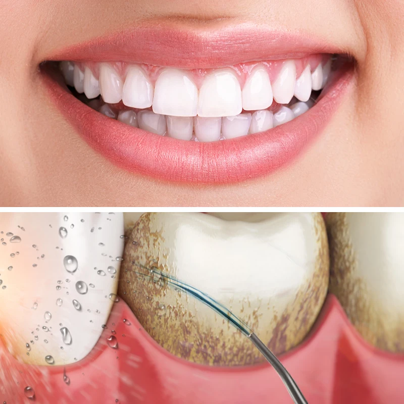 Oral Irrigator Water Flosser Portable Dental Water Jet 150ML Water Tank Waterproof Teeth Cleaner Nursing Tool
Oral Irrigator Water Flosser Portable Dental Water Jet 150ML Water Tank Waterproof Teeth Cleaner Nursing Tool