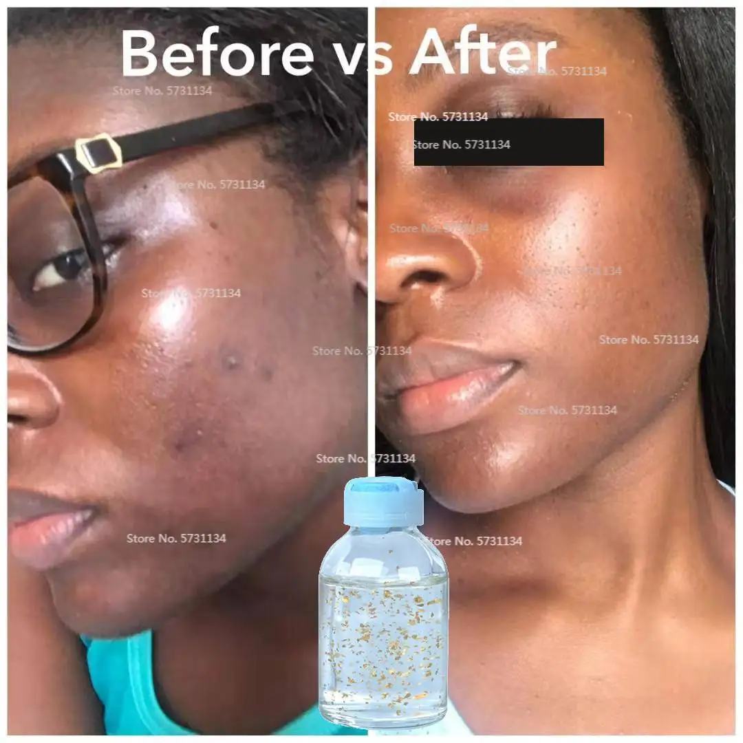 24K Pure Gold Collagen Infused Serum, Anti-Aging Anti-Redness Anti-Wrinkle Acne Treatment Skin Whitening 30ml Korian Skin Care 
24K Pure Gold Collagen Infused Serum, Anti-Aging Anti-Redness Anti-Wrinkle Acne Treatment Skin Whitening 30ml Korian Skin Care