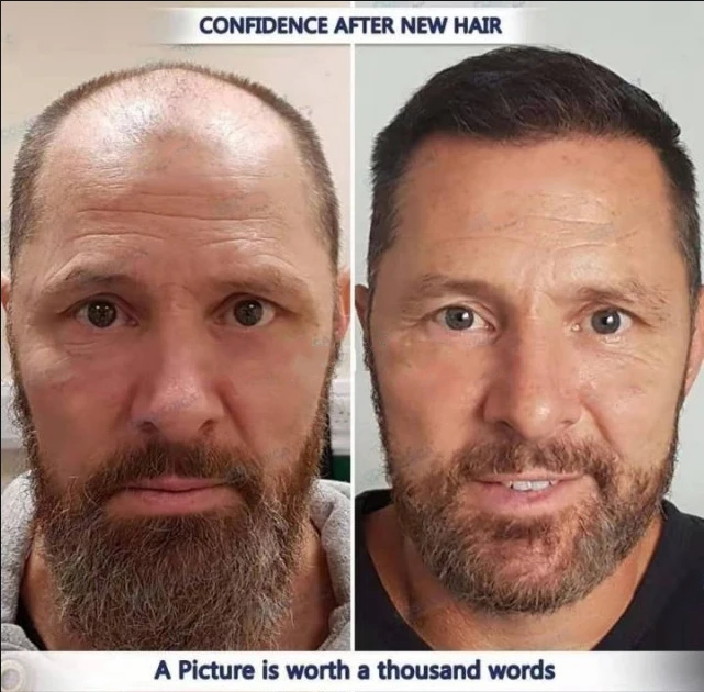 Ancient secret-hair growth shampoo, anti-hair loss treatment, wild growth, can be used for baldness
Ancient secret-hair growth shampoo, anti-hair loss treatment, wild growth, can be used for baldness