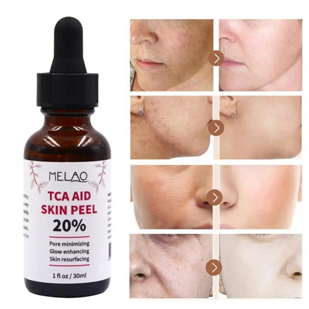 30ml Tca Aid Skin Peel Trichloroaectic Acid 20% Skin Peel Pore Care Wrinkles Minizing Pore Peel Face Skin Serum Spots
30ml Tca Aid Skin Peel Trichloroaectic Acid 20% Skin Peel Pore Care Wrinkles Minizing Pore Peel Face Skin Serum Spots