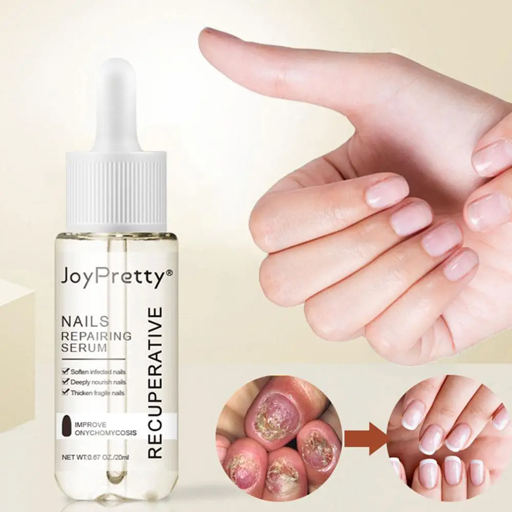 Fungal Nail Treatment Serum Onychomycosis Paronychia Anti-Fungal Nail Infection Removal Gel Foot Repair Essence Oil 
Fungal Nail Treatment Serum Onychomycosis Paronychia Anti-Fungal Nail Infection Removal Gel Foot Repair Essence Oil