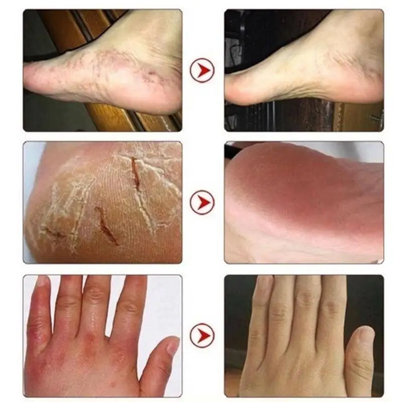 Antifreeze Cracking Foot Cream Repair Chapped Frostbite Moisturize Dead Skin Beauty Care Cream Skin Remove K9N6
Antifreeze Cracking Foot Cream Repair Chapped Frostbite Moisturize Dead Skin Beauty Care Cream Skin Remove K9N6