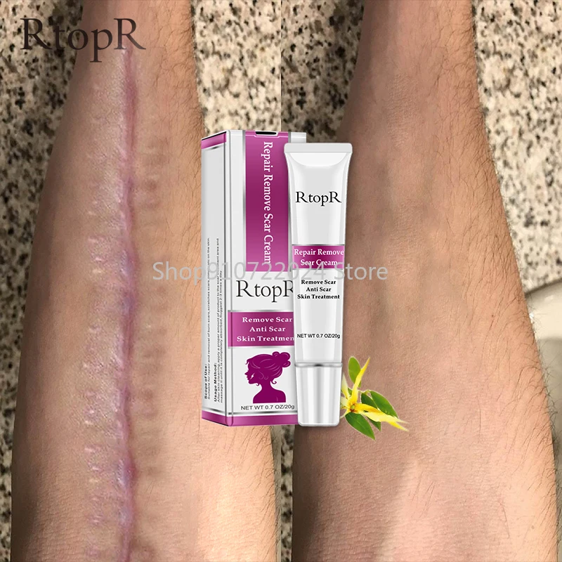 20G Remover Cream Acne Scar Stretch Marks Skin Repair Face Cream Acne Spots Acne Treatment Blackhead Whitening Cream Skin Care
20G Remover Cream Acne Scar Stretch Marks Skin Repair Face Cream Acne Spots Acne Treatment Blackhead Whitening Cream Skin Care