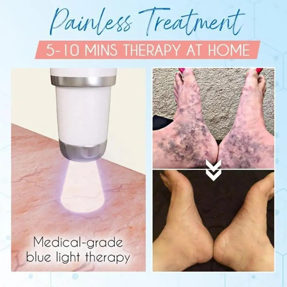 Heath Blue Light Therapy Varicose Veins Treatment Pen Removal Treatment Massage Scar Pen Acne Soft Cream and S8X8
Heath Blue Light Therapy Varicose Veins Treatment Pen Removal Treatment Massage Scar Pen Acne Soft Cream and S8X8
