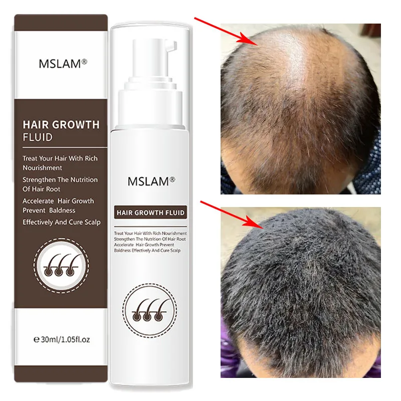

Hair Growth Essence Prevent Hair Loss Improve Hair Follicles Nourish Hair Roots Promote Hair Growth Oil Control Repair Hair Care
