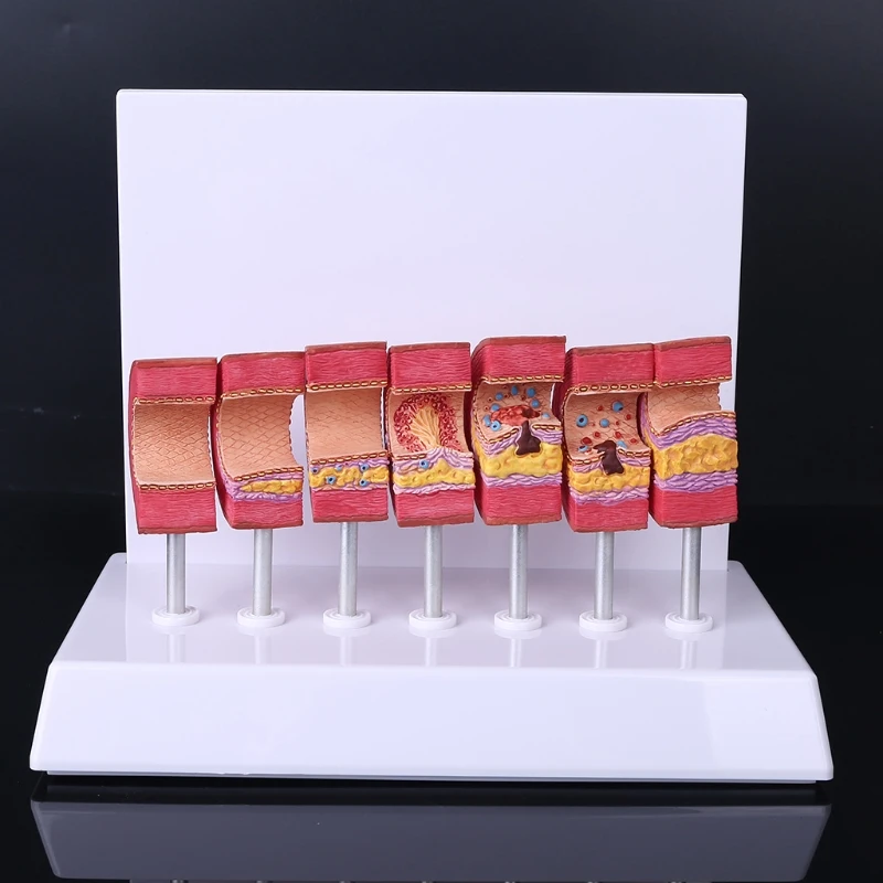 Human Atherosclerosis Model Artery Pathology Anatomical Blood Vessel Anatomy Thrombus 1XCE
Human Atherosclerosis Model Artery Pathology Anatomical Blood Vessel Anatomy Thrombus 1XCE