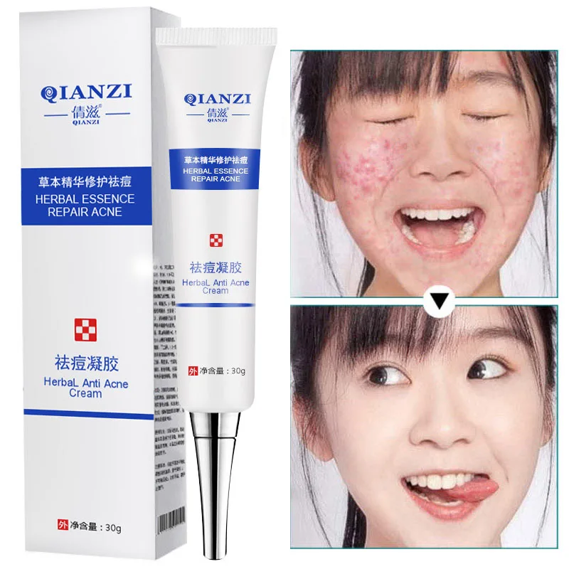 Acne Cream Fades Acne Marks and Repairs Blackheads Oil Control Shrinks Pores Whitening Anti-aging Moisturizing Cream Skin Care
Acne Cream Fades Acne Marks and Repairs Blackheads Oil Control Shrinks Pores Whitening Anti-aging Moisturizing Cream Skin Care