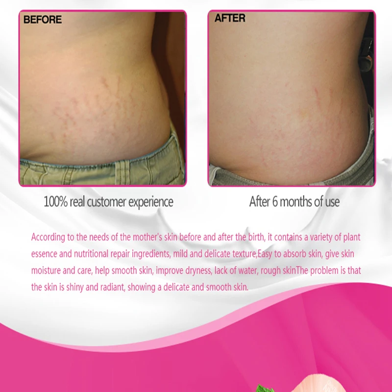 Effectively Repair Stretch Marks Removal Remover Plant Natural Heal Pregnancy Breast Hip Legs Stretch Mark Cream
Effectively Repair Stretch Marks Removal Remover Plant Natural Heal Pregnancy Breast Hip Legs Stretch Mark Cream