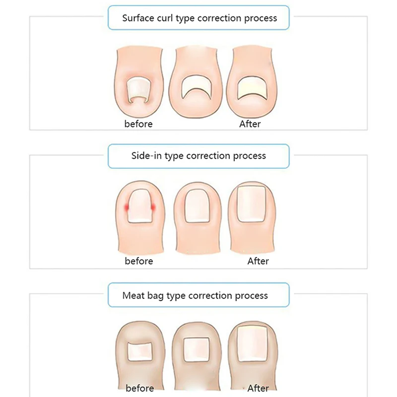 10 pcs/box Correction Sticker Patch Paronychia Corrector File Elastic Patch Corrector
10 pcs/box Correction Sticker Patch Paronychia Corrector File Elastic Patch Corrector