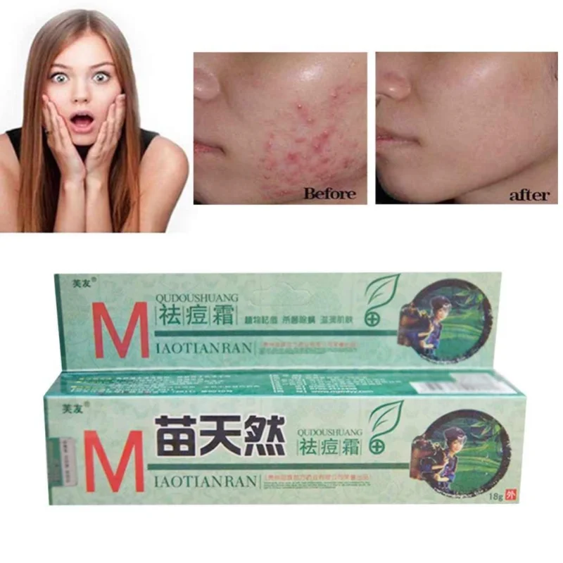 Acne Cream Sterilization and Mite Removal Nourishing Skin Care Repair and Treatment of Acne Marks Whitening Moisturizing Cream
Acne Cream Sterilization and Mite Removal Nourishing Skin Care Repair and Treatment of Acne Marks Whitening Moisturizing Cream