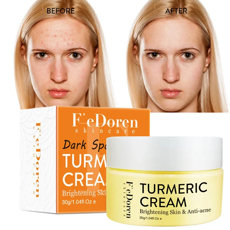 Отбеливающий увлажняющий крем для лица, от акне и темных пятен 
Отбеливающий увлажняющий крем для лица, от акне и темных пятен