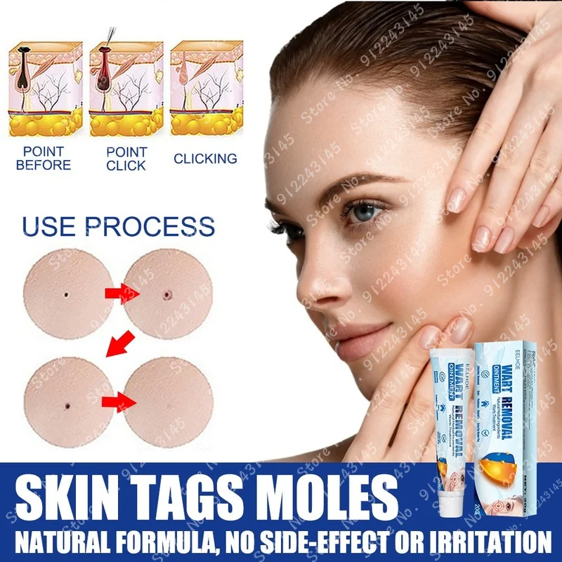 1 Piece of Wart Remover Antibacterial Ointment Wart Treatment Cream Skin Label Remover Herbal Extract Corn Cream Wart Ointment
1 Piece of Wart Remover Antibacterial Ointment Wart Treatment Cream Skin Label Remover Herbal Extract Corn Cream Wart Ointment