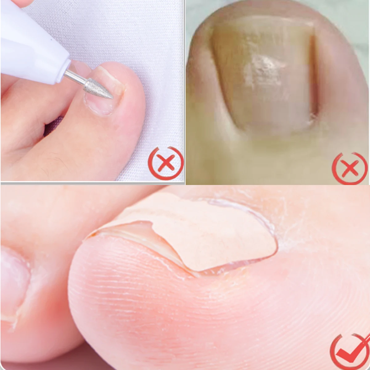 20/50/100pcs Nail Correction Stickers Ingrown Toenail Corrector Patches Paronychia Treatment Recover Corrector Pedicure Tools
20/50/100pcs Nail Correction Stickers Ingrown Toenail Corrector Patches Paronychia Treatment Recover Corrector Pedicure Tools