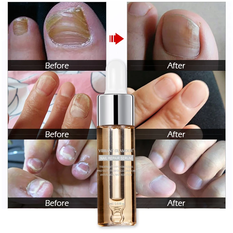 VIBRANT GLAMOUR Antibacterial Nail Treatments Liquid Nail Fungus Art Repair Tools Foot Nail Care Improve Repair Cream
VIBRANT GLAMOUR Antibacterial Nail Treatments Liquid Nail Fungus Art Repair Tools Foot Nail Care Improve Repair Cream