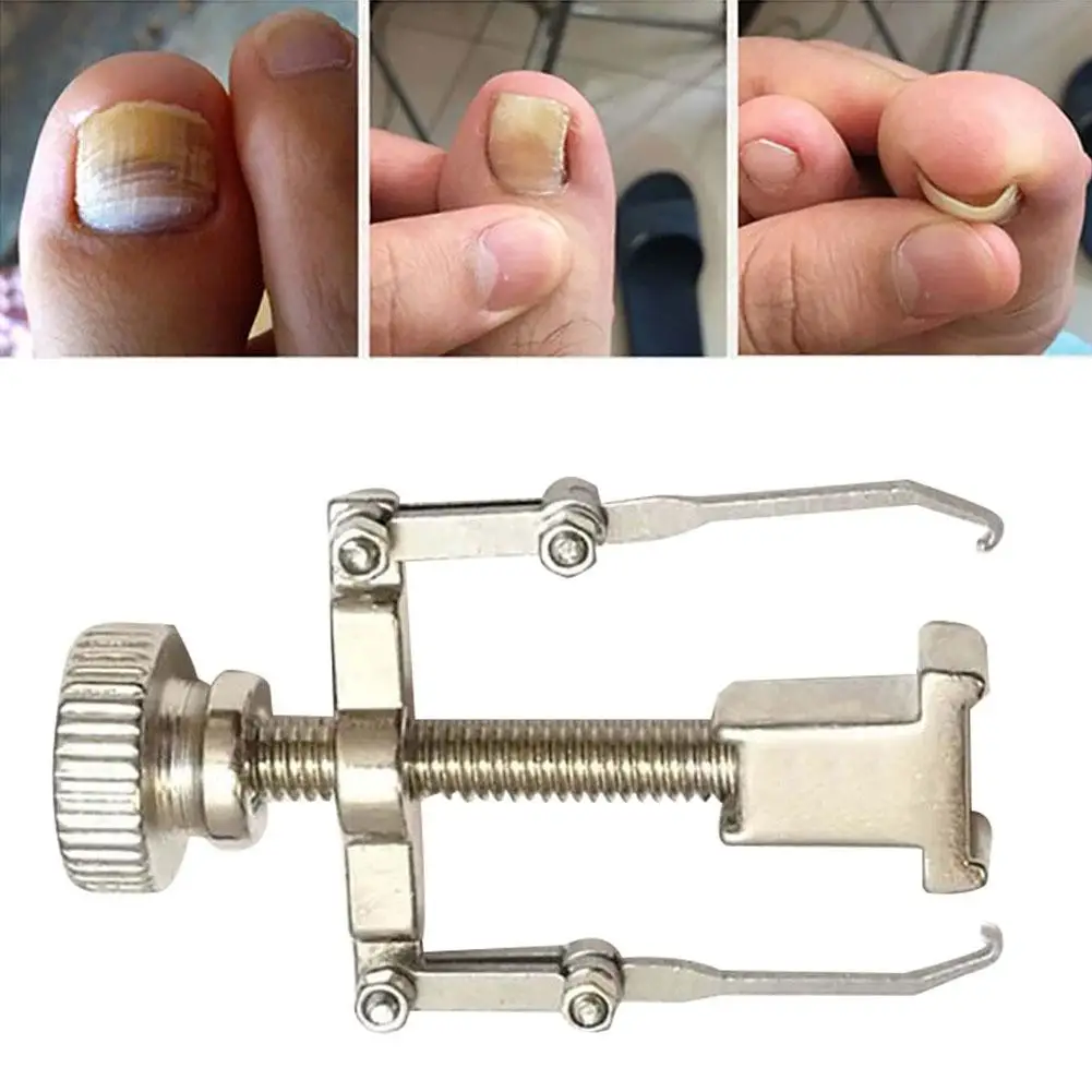 

Ingrown Toenail Toe Fixer Recover Correction Device Pedicure Foot Nail Care Tool Brace corrector Wire Fixer Straightening Clip