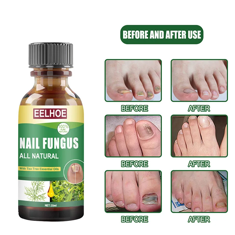 30ml Fungal Nail Repair Essences Serum A Paronychia Onychomycosis Treatments Care Foot Nail Fungus Removal Gel
30ml Fungal Nail Repair Essences Serum A Paronychia Onychomycosis Treatments Care Foot Nail Fungus Removal Gel