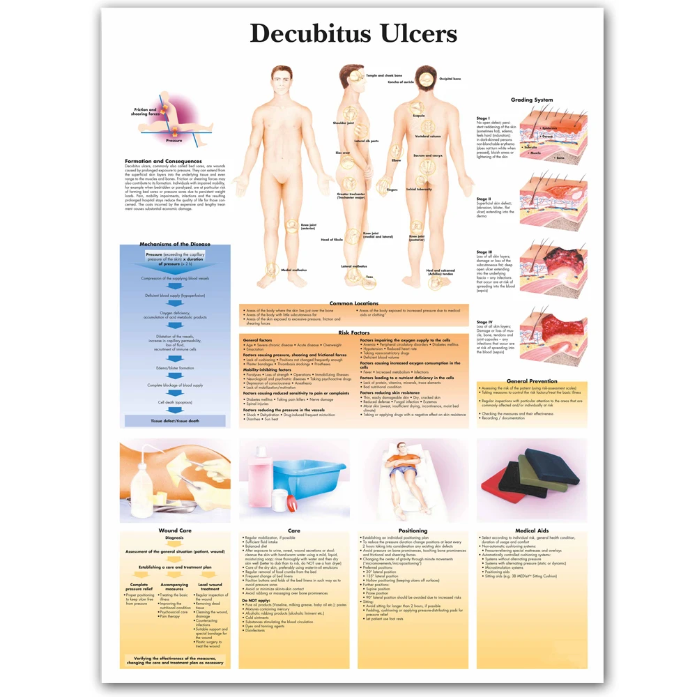 WANGART Decubitus Ulcers Chart Art Poster Print Body Map Canvas Wall Pictures for Medical Education Home Decor | Дом и сад