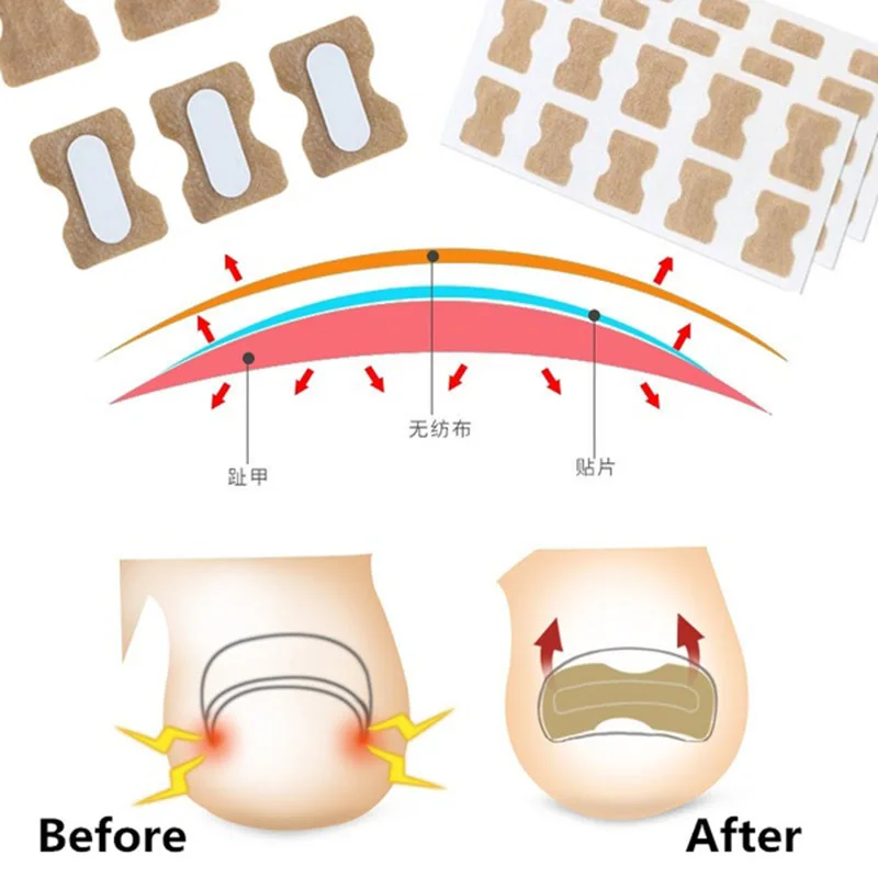 Ingrown Toenail Corrector Sticker Paronychia Treatment Fixer Recover Corrector Pedicure Foot Toe Nail Care Tool Glue Free
Ingrown Toenail Corrector Sticker Paronychia Treatment Fixer Recover Corrector Pedicure Foot Toe Nail Care Tool Glue Free
