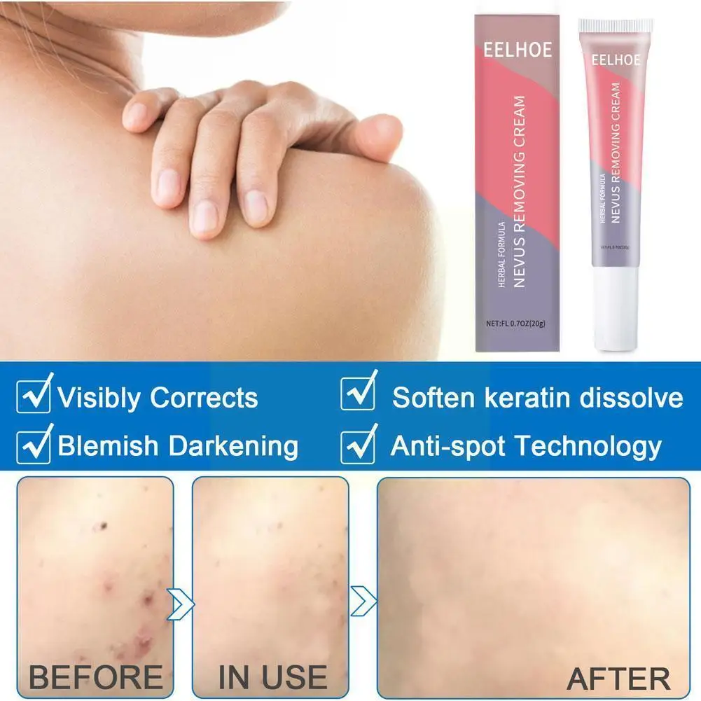 20g Beauty Point Mole Cream Skin Tag Remover Wart Treatment Skin Cream Moles Remover Treatment Care Acne Against Cream Scar D8P6
20g Beauty Point Mole Cream Skin Tag Remover Wart Treatment Skin Cream Moles Remover Treatment Care Acne Against Cream Scar D8P6