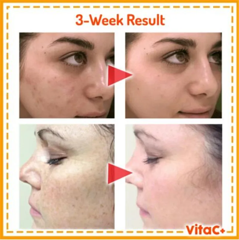 15ml Vitamin C Blemish Removal Gel Whitening Anti Freckle Cream Pen Effective Remove The Freckle Pigmented Melanin Spots
15ml Vitamin C Blemish Removal Gel Whitening Anti Freckle Cream Pen Effective Remove The Freckle Pigmented Melanin Spots