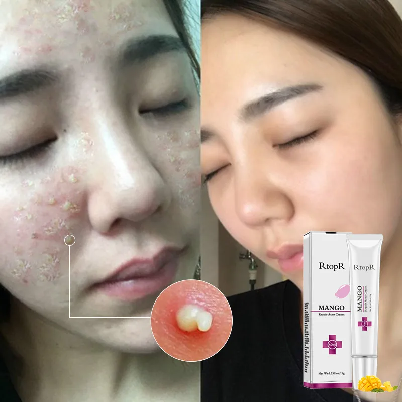 Repair Acne крем против пятен лечение шрамов, от угрей крем против угрей сужающийся поры отбеливающий увлажняющий уход за кожей лица 15 г
Repair Acne крем против пятен лечение шрамов, от угрей крем против угрей сужающийся поры отбеливающий увлажняющий уход за кожей лица 15 г