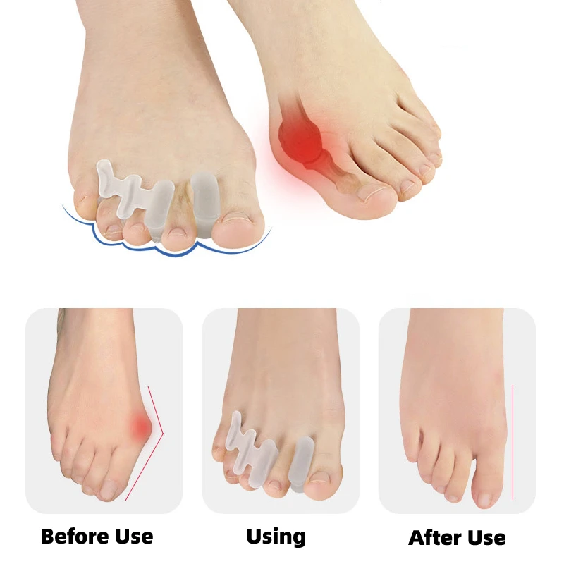 16pcs/8pairs Bunion Corrector Foot Care Tools Gel Pads Toes Straightener Silicone Hallux Valgus Protector Pedicure Separators
16pcs/8pairs Bunion Corrector Foot Care Tools Gel Pads Toes Straightener Silicone Hallux Valgus Protector Pedicure Separators
