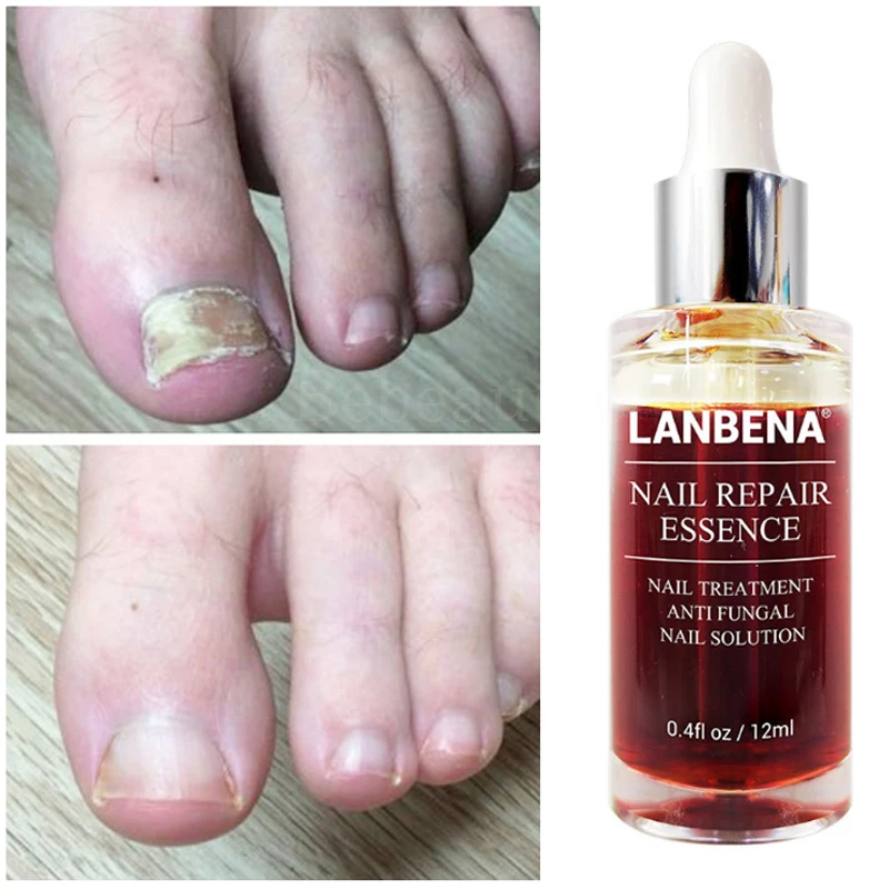 Крем от грибка ногтей лабена восстановление грибков на ногах Lanbena против онихомикоза средство для ног Lambena противогрибковый гриб для ног
Крем от грибка ногтей лабена восстановление грибков на ногах Lanbena против онихомикоза средство для ног Lambena противогрибковый гриб для ног