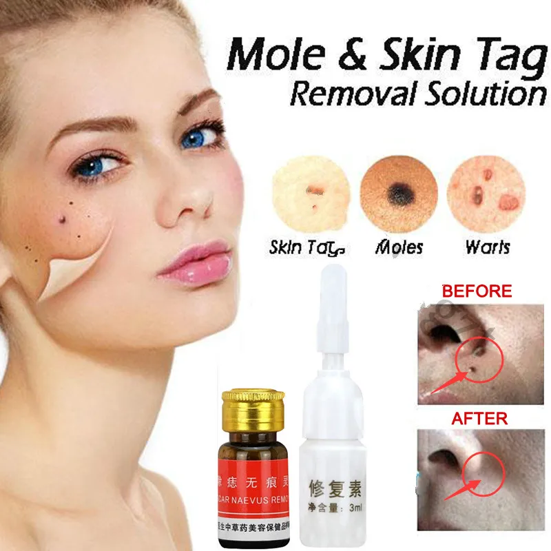 Mole & Skin Tag Removal Solution Painless Mole Skin Dark Spot Removal Face Wart Tag Freckle Removal Cream Oil Plaster
Mole & Skin Tag Removal Solution Painless Mole Skin Dark Spot Removal Face Wart Tag Freckle Removal Cream Oil Plaster