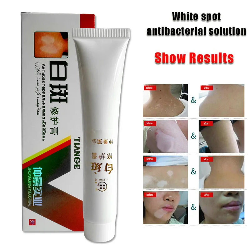 

Китайский травяной крем для Vitiligo, лечение лечения лейкоплакии белыми пятнами SDFA88