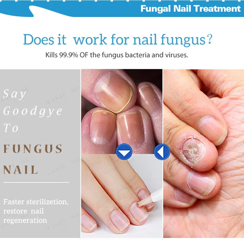 Nail Treatment Pen Onychomycosis Paronychia Anti Fungal Nail Infection Chinese Herbal Toe Fungus Care Repair Serum
Nail Treatment Pen Onychomycosis Paronychia Anti Fungal Nail Infection Chinese Herbal Toe Fungus Care Repair Serum