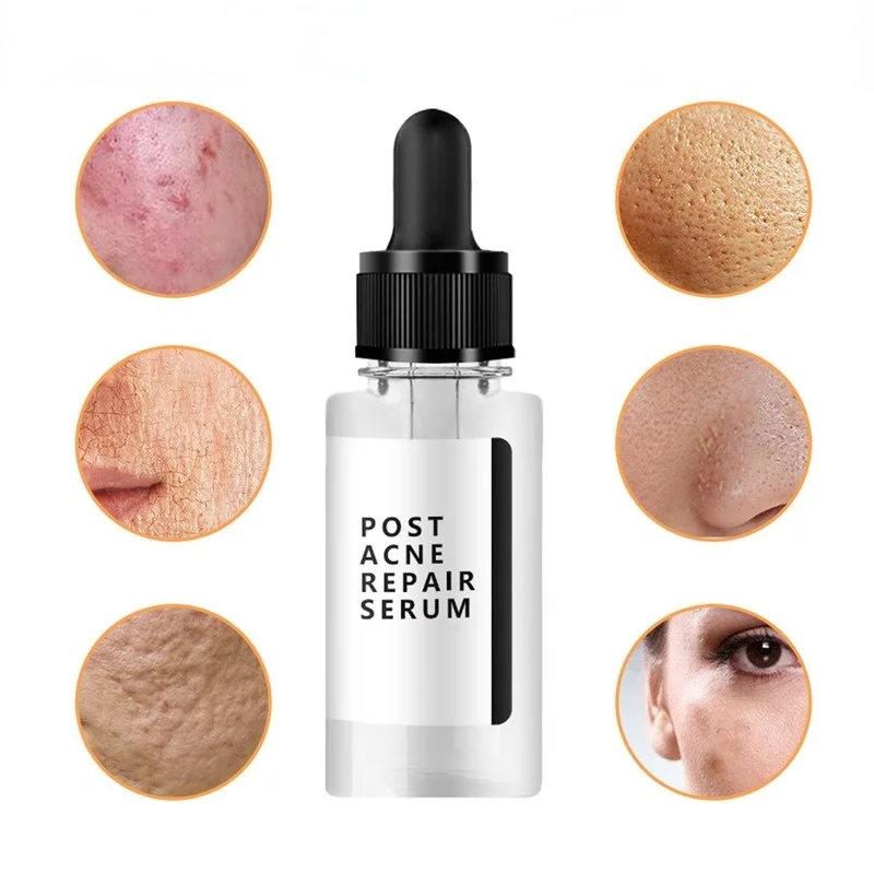 Acne Treatment Essence Facial Acne Marks Acne Repair Essence Skin Moisturizing and Hydrating Skincare Whitening Cream
Acne Treatment Essence Facial Acne Marks Acne Repair Essence Skin Moisturizing and Hydrating Skincare Whitening Cream
