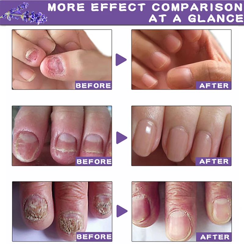 Gel Infection Toe Onychomycos Anti Paronychia Removal Eseeence Foot Feet Treatment 10ml Nail
Gel Infection Toe Onychomycos Anti Paronychia Removal Eseeence Foot Feet Treatment 10ml Nail