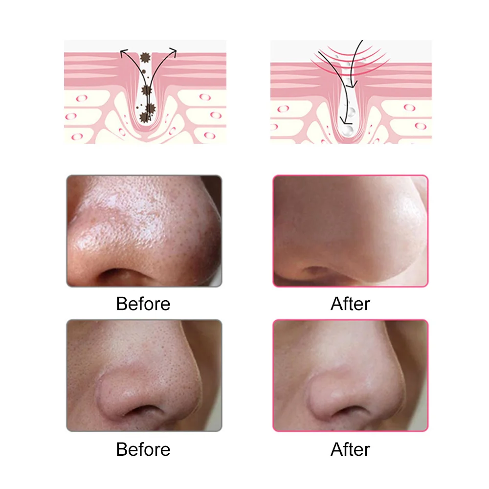 Blackhead Remover Visual Face Deep Nose Cleaner T Zone Pore Acne Pimple Removal Vacuum Suction Facial Beauty Clean Skin Tool
Blackhead Remover Visual Face Deep Nose Cleaner T Zone Pore Acne Pimple Removal Vacuum Suction Facial Beauty Clean Skin Tool