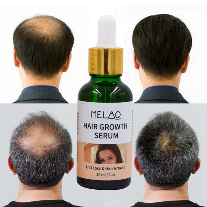 30ml Reccomend Hair Growth Serum Hair Loss Treatment Essential Oil Anti Hair Loss Dense Hairs Root Repair
30ml Reccomend Hair Growth Serum Hair Loss Treatment Essential Oil Anti Hair Loss Dense Hairs Root Repair