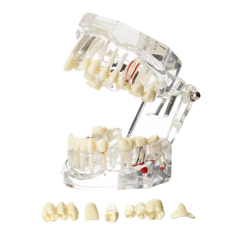 Dental Model Teeth Implant Restoration Bridge Teaching Study Tooth Medical Science Disease Dentist Dentistry Products
Dental Model Teeth Implant Restoration Bridge Teaching Study Tooth Medical Science Disease Dentist Dentistry Products
