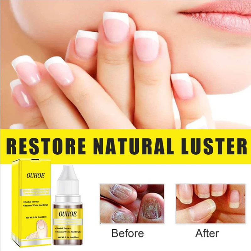 Fungal Nail Repair Essence Herbal Anti Fungus Treatment Onychomycosi Paronychia Anti-Fungal Anti-Infective Toe Nails Care 1 PC
Fungal Nail Repair Essence Herbal Anti Fungus Treatment Onychomycosi Paronychia Anti-Fungal Anti-Infective Toe Nails Care 1 PC