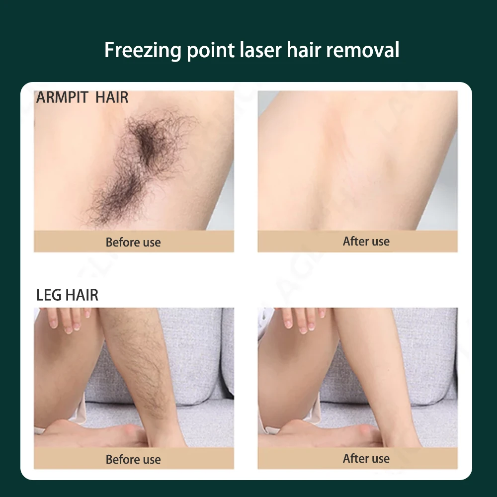 Laser Epilator Laser Hair Removal Device Bikini epilator for women depiladora facial depilation photo permanent Pulsed light
Laser Epilator Laser Hair Removal Device Bikini epilator for women depiladora facial depilation photo permanent Pulsed light