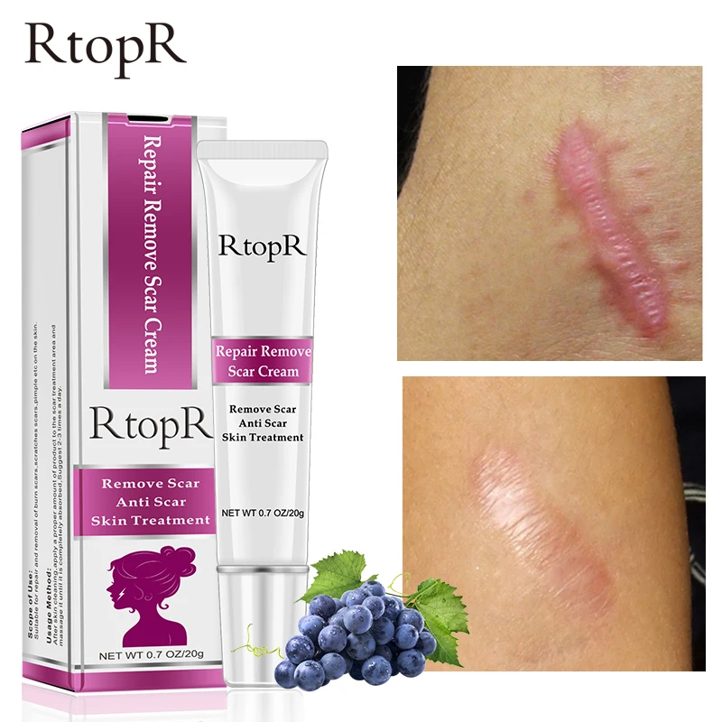 RtopR Acne Scar Removal Cream Repair Stretch Marks Gel Burn Scars Surgical Scar Repair Treatment Whitening Smooth Body Skin Care
RtopR Acne Scar Removal Cream Repair Stretch Marks Gel Burn Scars Surgical Scar Repair Treatment Whitening Smooth Body Skin Care