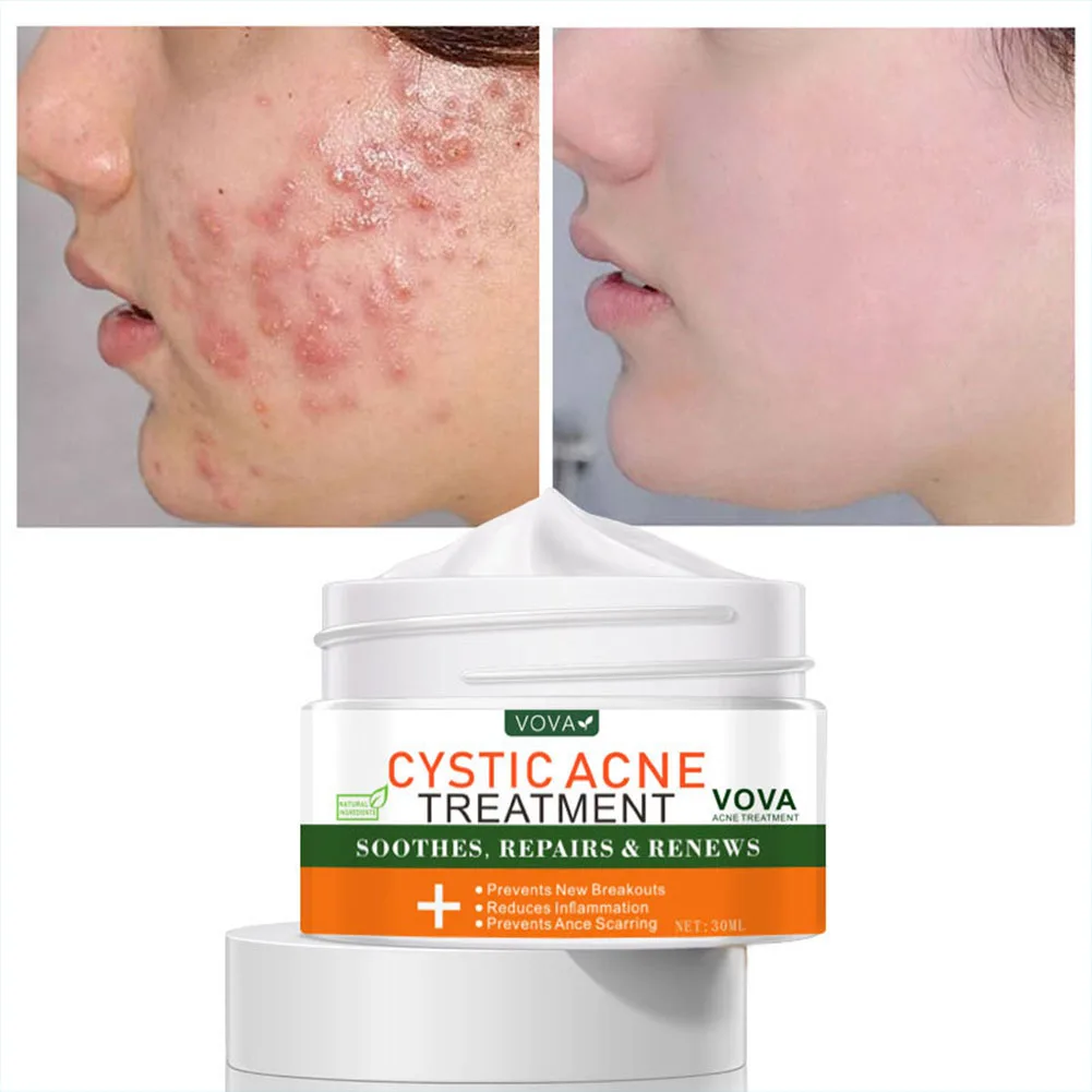 VOVA Scar Acne Removal Cream Stretch Marks Pimples Facial Gel Remove Acne Smoothing Moisturizing Whitening Body Skin Care TSML1
VOVA Scar Acne Removal Cream Stretch Marks Pimples Facial Gel Remove Acne Smoothing Moisturizing Whitening Body Skin Care TSML1