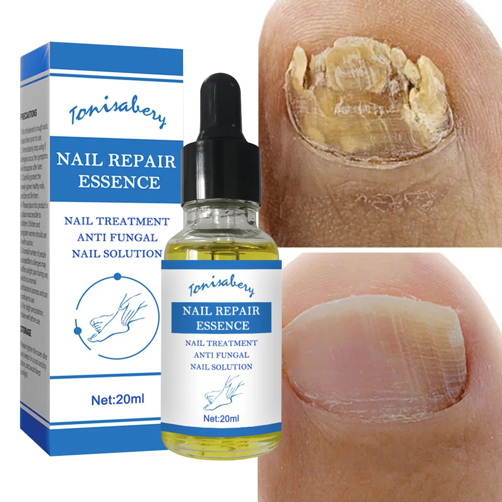 Nail Fungal Treatment Feet Care Essence Nail Foot Care Toe Nail Fungus Removal Gel Anti Infection Paronychia Onychomycosis 20ML
Nail Fungal Treatment Feet Care Essence Nail Foot Care Toe Nail Fungus Removal Gel Anti Infection Paronychia Onychomycosis 20ML