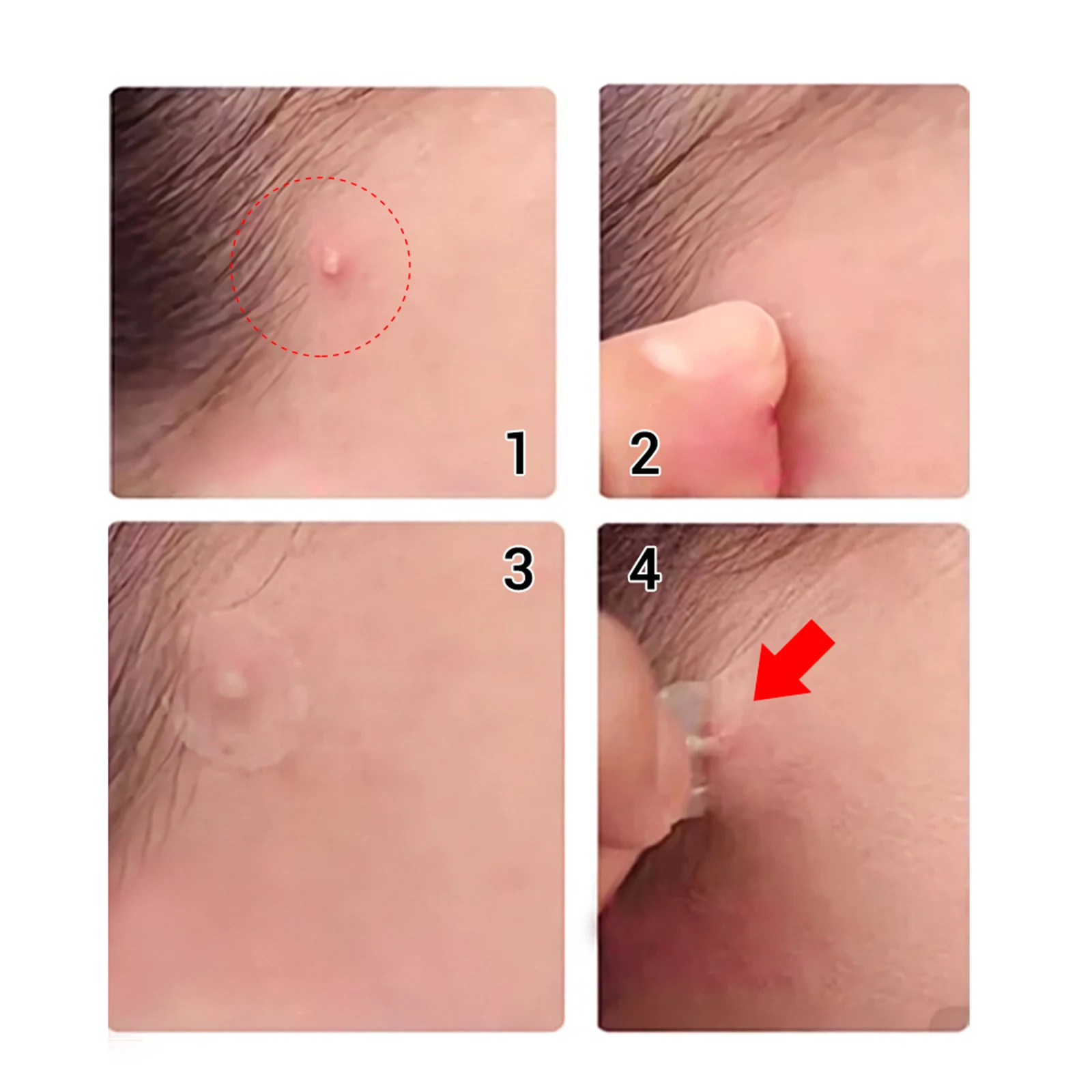 Acne Blackhead Patch Invisible Acne Stickers Blemish Treatment Blackhead Remover Skin Care Beauty Tool J9
Acne Blackhead Patch Invisible Acne Stickers Blemish Treatment Blackhead Remover Skin Care Beauty Tool J9