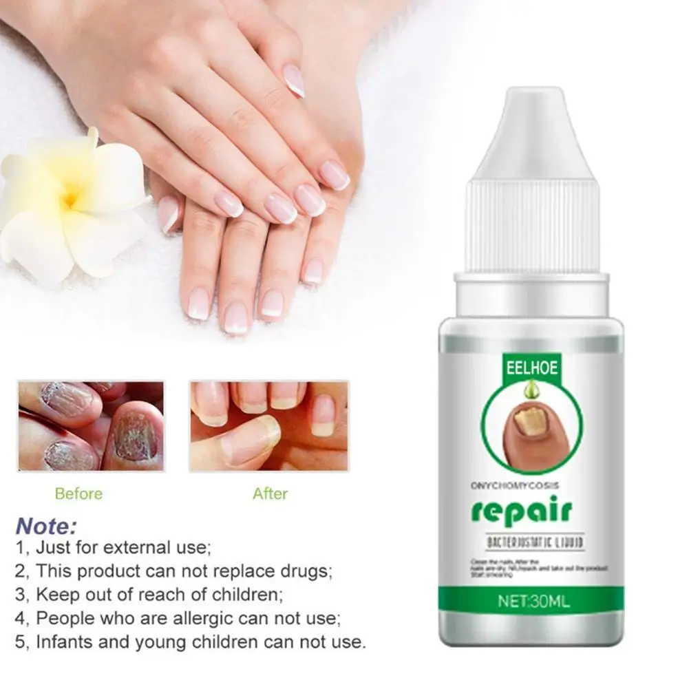 Fungal Nail Treatment Feet Care Essence Onychomycosis Paronychia Anti-Fungal Nail Infection Herbal Toe Fungus Removal Serum
Fungal Nail Treatment Feet Care Essence Onychomycosis Paronychia Anti-Fungal Nail Infection Herbal Toe Fungus Removal Serum