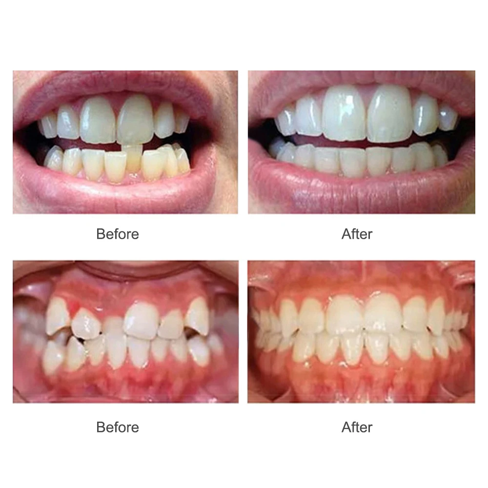 Dental Appliance Tooth Orthodontic Braces Trainer Dental Braces Teeth Trainer Alignment Braces Mouthpiece For Adults Orthodontic
Dental Appliance Tooth Orthodontic Braces Trainer Dental Braces Teeth Trainer Alignment Braces Mouthpiece For Adults Orthodontic
